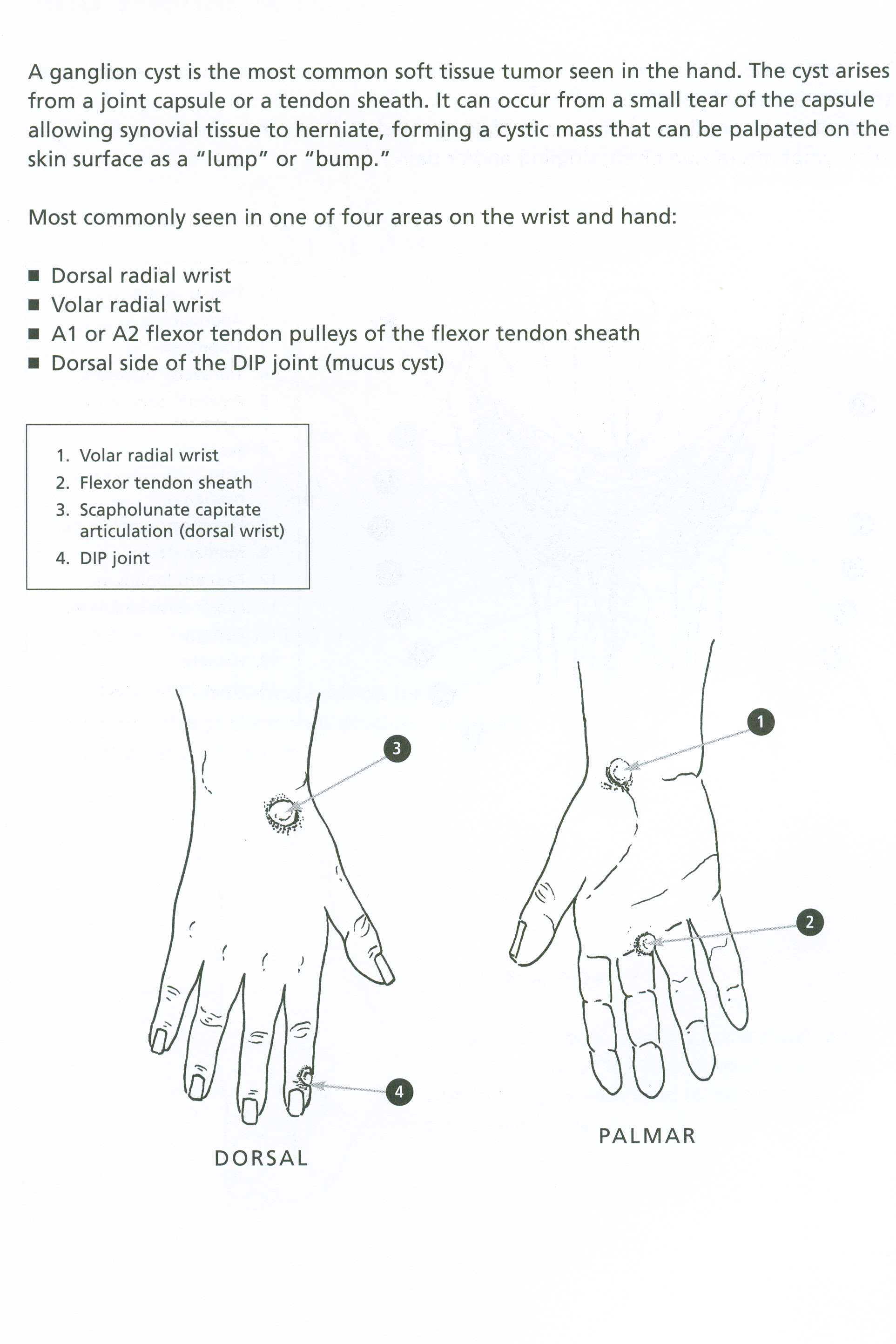 Thumb Ganglion Cyst